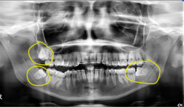 Dente del giudizio. Toglierlo oppure no?