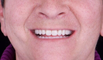 Implantologia carico immediato: la ricostruzione dei denti restituisce il sorriso perduto.