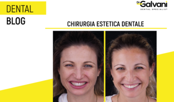 Come risolvere i problemi estetici e funzionali con la chirurgia plastica parodontale