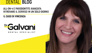 All-on-4 e parodontite avanzata: ritrovare il sorriso in un solo giorno.